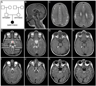 The Frog Xenopus as a Model to Study Joubert Syndrome: The Case of a Human Patient With Compound Heterozygous Variants in PIBF1